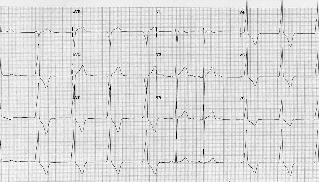 Accelerated-Idioventricular-Rhythm-AIVR-ECG-1